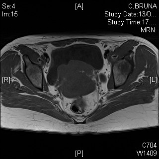 neurofibromatosi pelvica foto 2