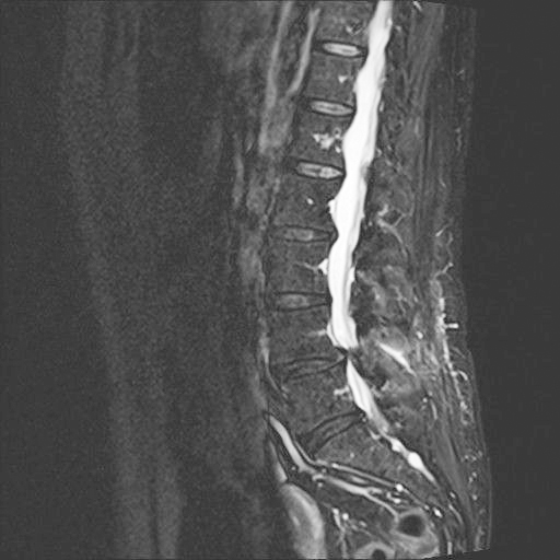 disfunzione vescico-uretrale neurogena secondaria a stenosi del canale lombare foto 1