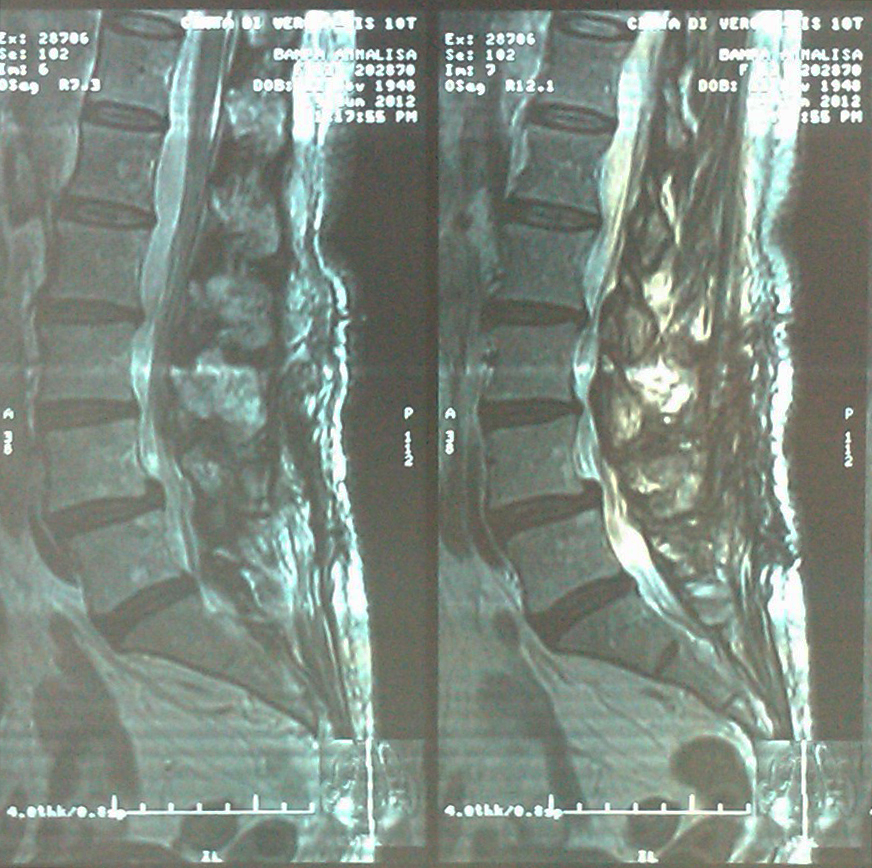 disfunzione vescico-uretrale neurogena secondaria a stenosi del canale lombare foto 2